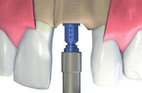 Paso 4: Orientar correctamente el implante Cuando vaya alcanzando la posición definitiva del implante, asegúrese de que las marcas de altura en el componente de transferencia azul estén orientadas