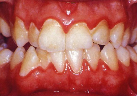 GINGIVITIS Inflamación de mucosa oral que rodea los dientes. Mala higiene oral.