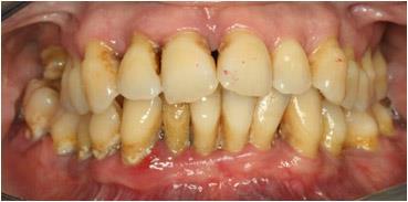 PERIODONTITIS Enfermedad inflamatoria que afecta los ligamentos periodontales, el hueso alveolar y el cementum. Produce destrucción del ligamento periodontal con la eventual caída del diente.
