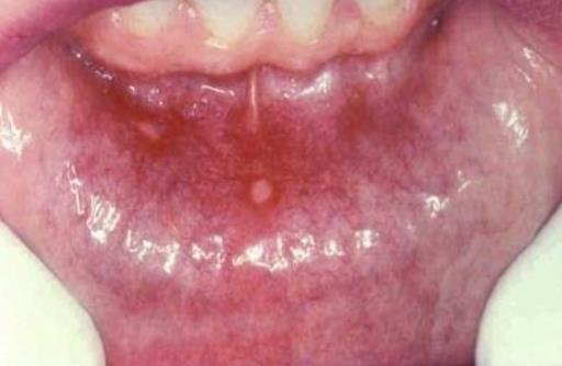 ÚLCERAS AFTOSAS Úlceras en mucosa oral superficial, dolorosas, recurrentes, comunes. En el 40% de la población, en las primeras 2 décadas de vida.