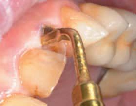 SEGURIDAD EN LA CONSULTA Û EXTRACCIONES Cuando se debe a infecciones, correcciones ortodónticas o para abrir espacios para la dentición permanente en maxilar de un niño: a veces la extracciones no