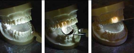 Transiluminación Las caries interproximales en los dientes anteriores, usualmente pueden ser