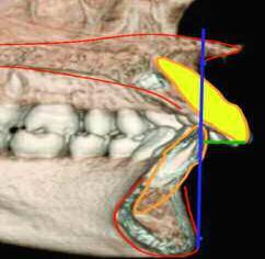 Inclinación del incisivo inferior: ángulo formado entre el eje longitudinal del incisivo inferior (A) y la línea dentaria (A-Pog).