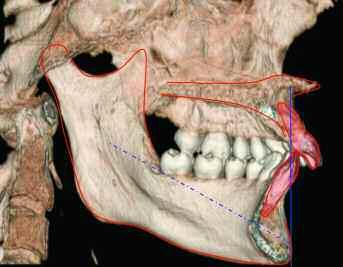 Figura.28. La distancia en milímetros desde el punto Xi, centro de la rama mandibular, y la línea A-Pog representa la longitud del cuerpo mandibular.