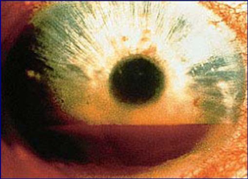 7. HIFEMA - Es la presencia de sangre en la CA - Lesión GRAVE (potenciales complicaciones) - Producto de lesiones del iris o cuerpo