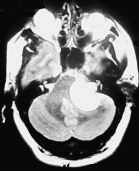 12 Ninguno de los tumores en este estudio presentó hidrocefalia como complicación, y los tumores de mayor tamaño no fueron los Schwannomas sino el glomus de la yugular y el aneurisma de la arteria