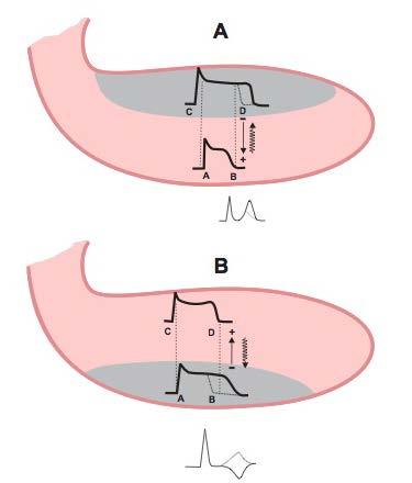 Imagen electrocardiográfica de isquemia Subendocárdica: Prolongación del PA subendocárdico por retraso en la repolarización Vector de isquemia dirigido hacia