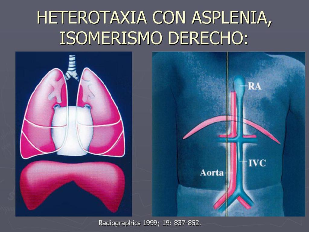 Fig. 5: Esquema de los hallazgos en heterotaxia con asplenia: tres lóbulos pulmonares bilaterales, cisuras menores en ambos pulmones, bronquios epiarteriales, aurícula sistémica