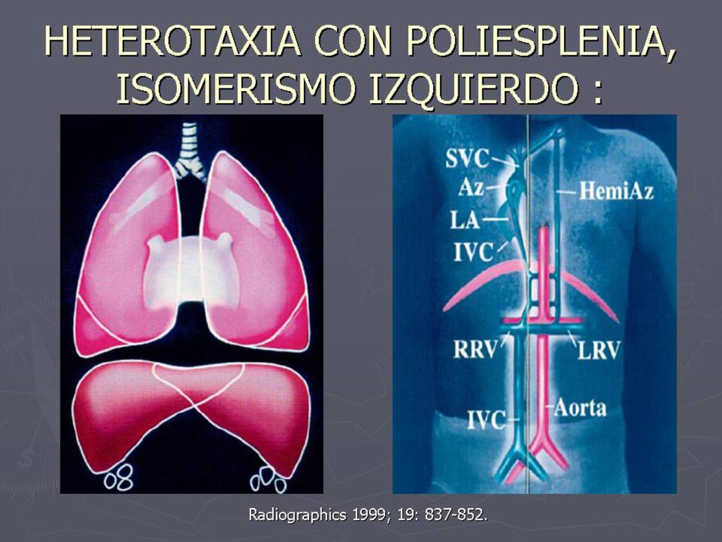 Fig. 6: Esquema de los hallazgos en heterotaxia con poliesplenia: dos lóbulos pulmonares bilaterales, bronquios hipoarteriales, aurícula pulmonar bilateral, hígado en