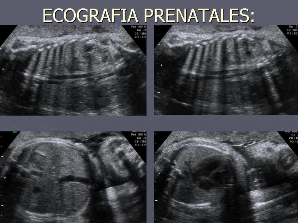 Fig. 8: Ecografía prenatal: Persistencia de la vena ácigos: Continuación de Vena Cava Inferior con la vena ácigos.