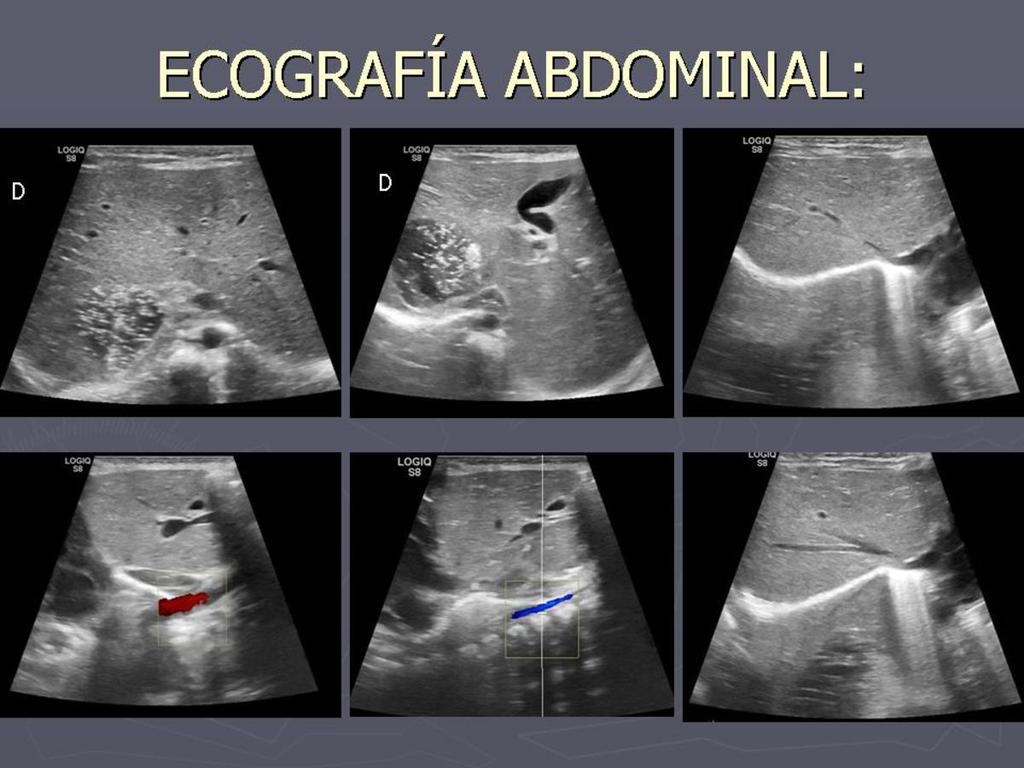 Fig. 10: Hallazgos ecografía abdominal: Hígado de disposición medial, en puente. Estómago a la derecha. Vesícula en línea media.