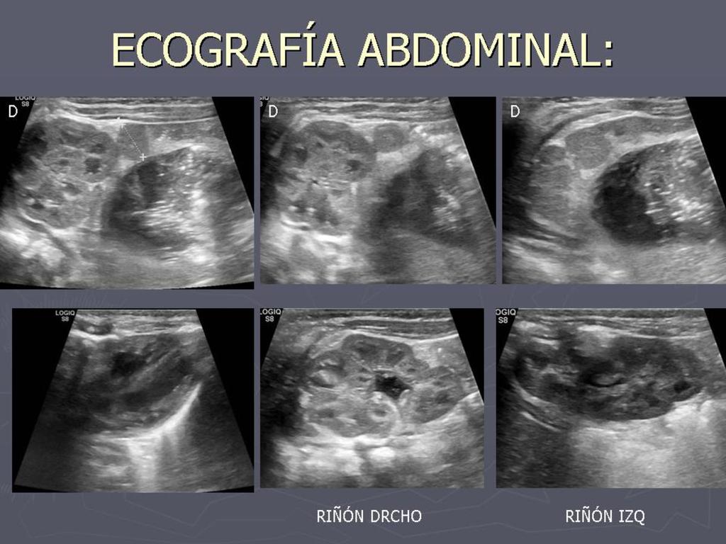 Fig. 11: Hallazgos ecografía abdominal: Poliesplenia.