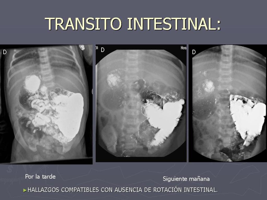 Fig. 13: Tránsito intestinal: Se objetiva una distribución de las asas de intestino