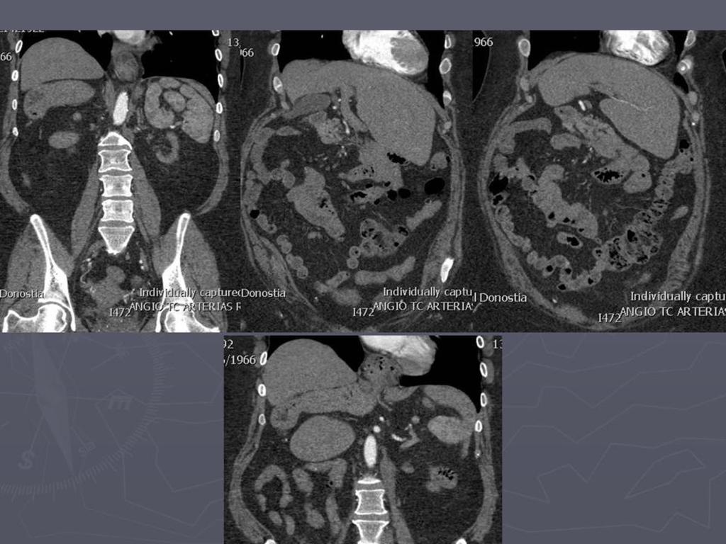 Fig. 17: AngioTC: Poliesplenia con múltiples bazos en hipocondrio izquierdo. Estómago de disposición a la derecha.