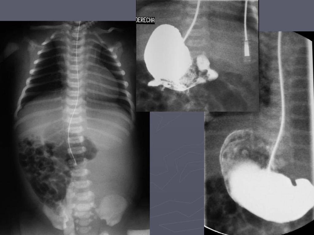 Fig. 20: Rx torax-abdomen previa al transito intestinal: corazón en hemitorax izquierdo.