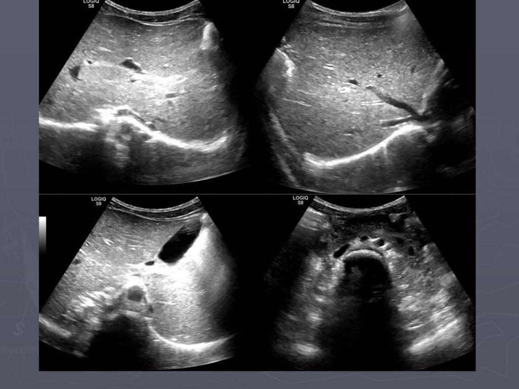 Fig. 22: Hallazgos ecografía abdominal: hígado en línea media, venas suprahepáticas con drenaje a aurícula