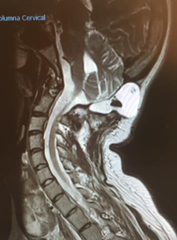 RMN craneal y columna cervical: Meningocele, con amplia comunicación del LCR, a nivel del agujero magno.