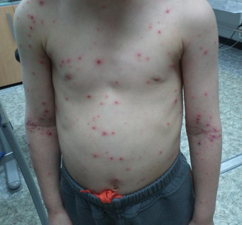 Casos de varicela en el colegio