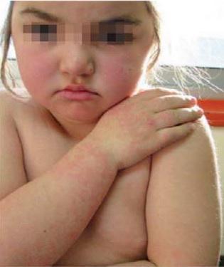 CASO CLÍNICO 4 Cristina, 7 años Lesiones diagnosticadas de urticaria.