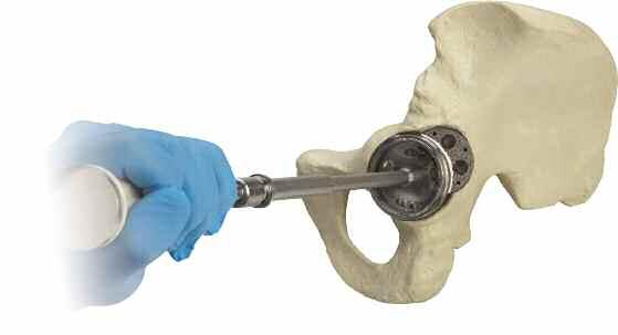 Paso 4: Implante del cotilo acetabular El aumento en cuña se fija al cotilo acetabular de acoplamiento aplicando cemento óseo.