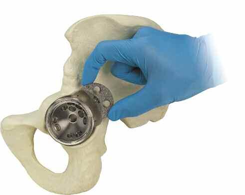 Opcional: Inserción del cotilo acetabular antes del aumento en cuña Existen algunas situaciones clínicas en las que con el implante del cotilo acetabular se obtiene una estabilidad insuficiente.