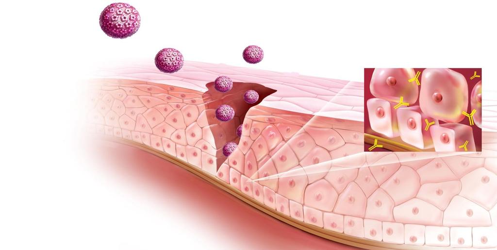 Protección mediada por Ac neutralizantes HPV Ac Neutralizantes Canal Cervical Epitelio Cervical Vaso sanguíneo Lesión epitelial Membrana