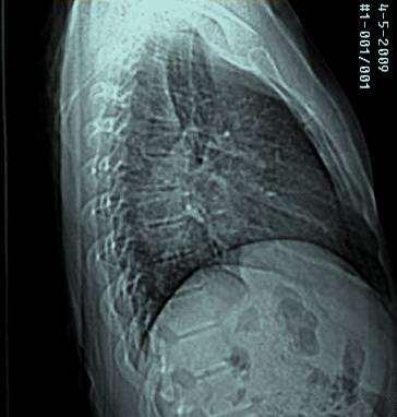 Se realiza estudio radiológico (Rx) de columna dorsal antero-posterior (AP) y lateral derecha, (Fig.