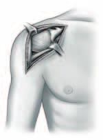 ABORDAJE QUIRÚRGICO Se practica una incisión deltopectoral recta, que comienza justamente lateral a la punta de la apófisis coracoides y se extiende en dirección distal y externa hasta la inserción