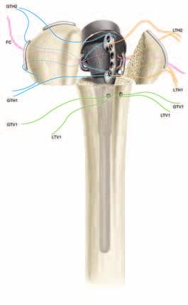 Fijación de las tuberosidades La fijación de las tuberosidades a la prótesis y a la diáfisis es crítica para el éxito del procedimiento.