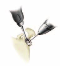 A continuación se coloca un retractor de una punta o doble punta a lo largo del cuello glenoideo. Alrededor de la glena se colocan separadores en dirección superior e inferior.