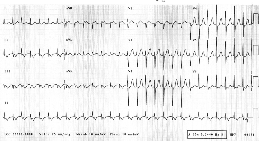 36-14 36-15 516 Taquicardia por movimiento circular antidrómica: se presenta como una taquicardia con complejos anchos (taquicardia preexcitada) con una frecuencia cardíaca promedio de 150