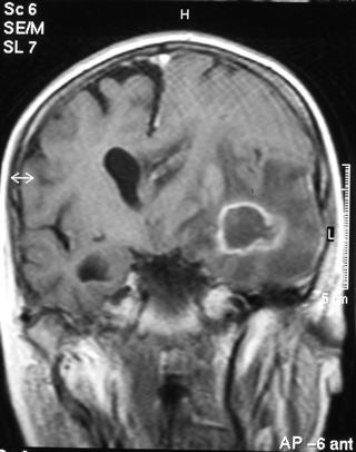 Aspergilosis cerebral 10-20% de los pacientes con AI. Depende del grado de inmunosupresión.