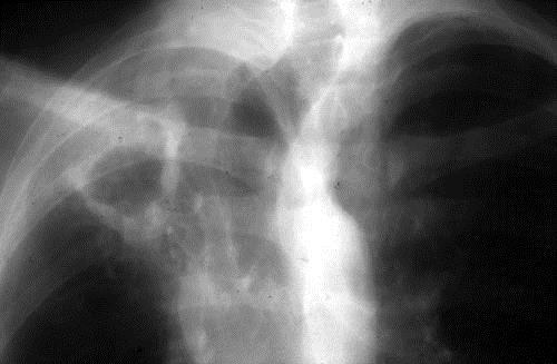 Aspergilosis pulmonar crónica o semiinvasora Factores de riesgo o EPOC
