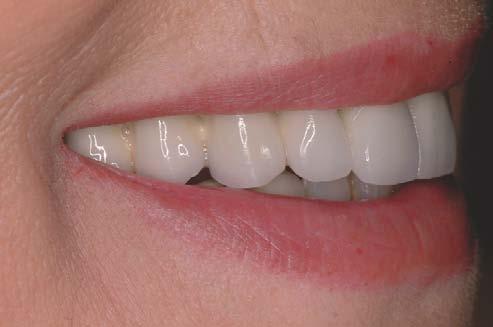 prótesis fija dentosoportada.
