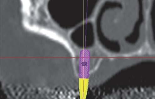 Planificación de implantes con TC Vista frontal de la planificación del tratamiento quirúrgico