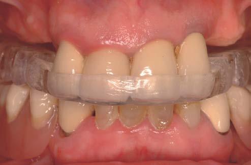 Férula quirúrgica La dimensión vertical está mantenida por los dientes anteriores.