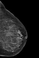 Paciente mujer de 79 años, con asimetría en desarrollo en mama derecha.