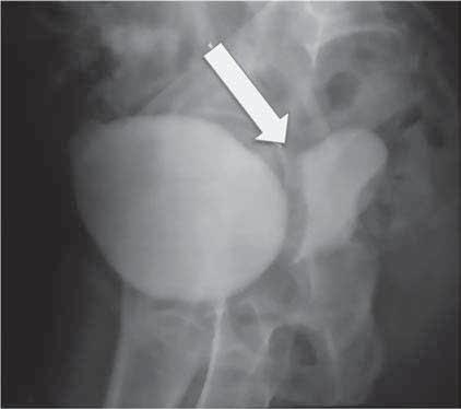 El cierre de la fístula se llevó a cabo con la técnica tradicional, además de colocar un reimplante ureteral izquierdo y un parche de epiplón.