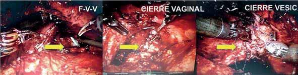 Corona-Montes VE y col. Fístula vesicovaginal recurrente Figura 5. Fístula vesicovaginal (A), cierre vesical (B) y cierre vaginal (C).