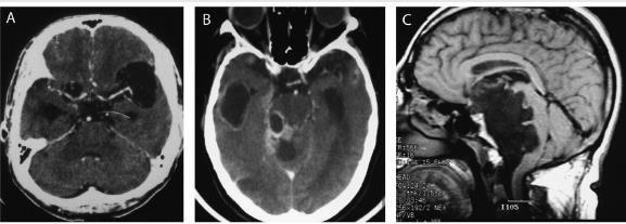 aracnoiditis fibrosa responsable del desarrollo de hidrocefalia se ve en la TAC o RM como áreas de realce leptomeníngeo anormal en la base del cerebro.