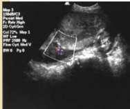 Cordocentesis 18-19s XXIII Reunión Científica SANAC Almería -Estudio rápido cariotipo fetal -Confirma mosaicismo de LA -Estudios
