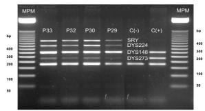 97% de los casos analizados fue normal para estudio de microdeleciones del cromosoma Y, en las diferentes regiones AZF a, b, c y proximal AZFc/AZFd, solo el 3,03%