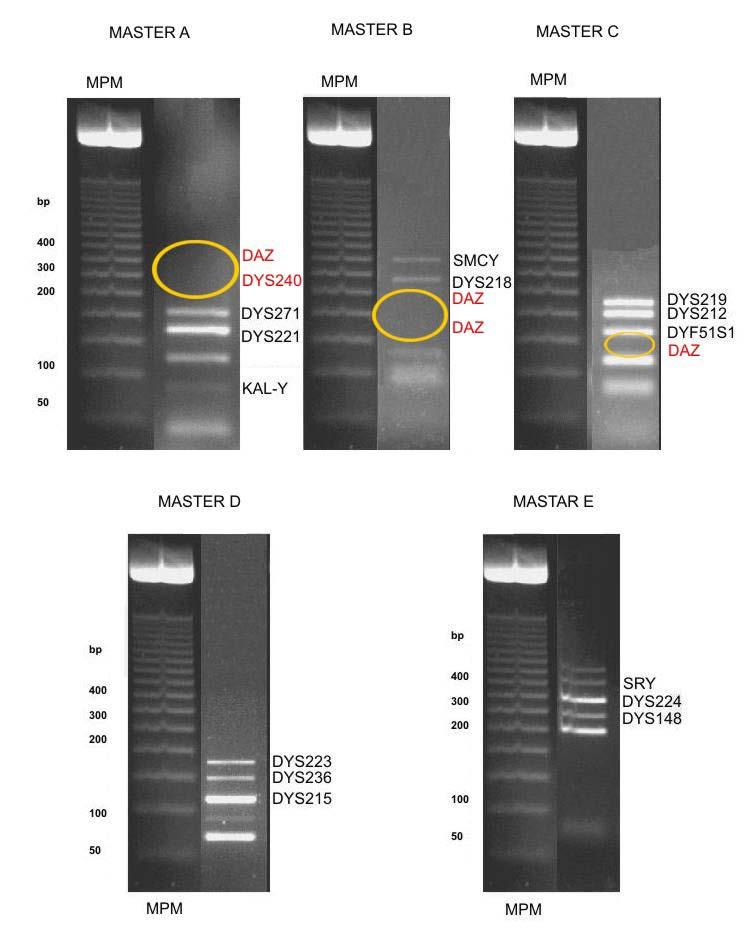 Microdeleciones de regiones AZF del cromosoma Y e infertilidad En los casos 1 al 30, 32 y 33, se observó presencia de todas las bandas génicas de acuerdo a los STSs estudiados, tanto para máster A,