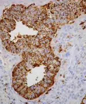 MARCADORES DE CANCER PULMONAR NAPSIN-A CK 7 y TTF-1 NAPSIN-A Novel Aspartic Proteinases of the Pepsin Family Más
