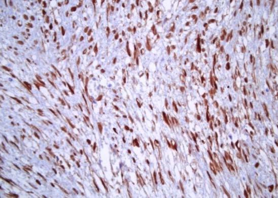Adhesión y signalización Fibromatosis: Mutación en la vía APC/beta catenina
