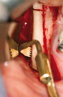 la izquierda* Tres dientes; 0,6mm de grosor Muestra de la mandíbula anterior unilateral