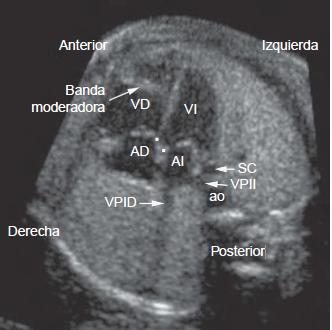 Análisis segmentario secuencial 2. Reconocimiento de morfología ventricular Anderson RH, Shirali G.