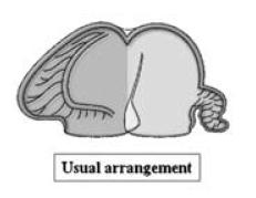 Situs atrial Orejuelas Flap del foramen oval Drenaje de VCI Jacobs JP, Anderson RH et al.