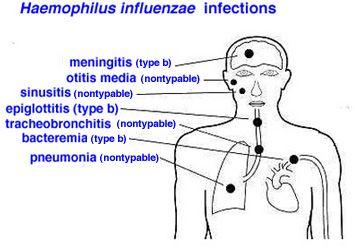 Haemophilus influenzae tipo b