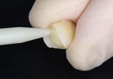 Acondicionamiento previo del diente Aplicación